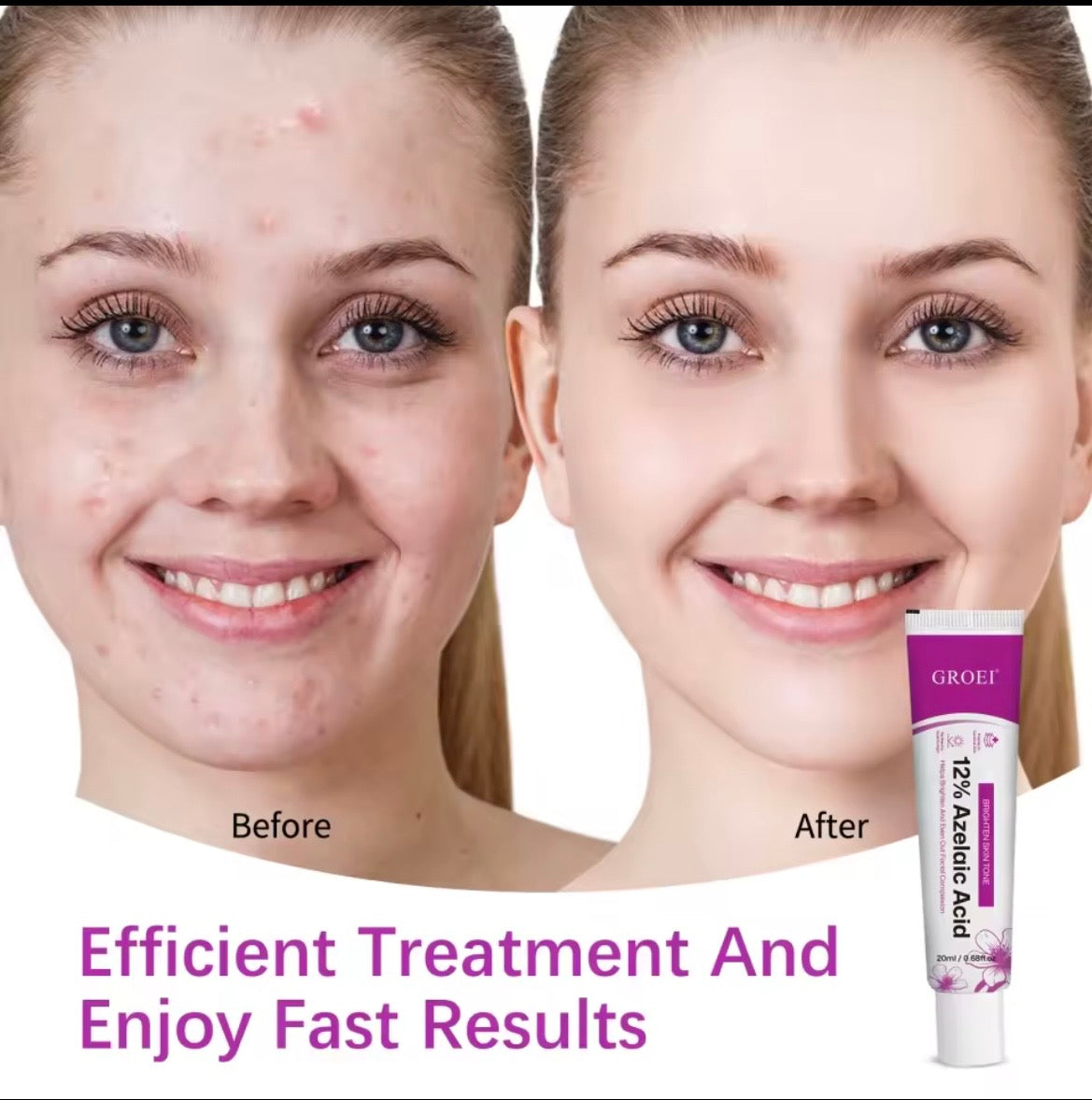 Groei 12% Azelaic Acid Cream – Brightening and Even-Tone Facial Treatment